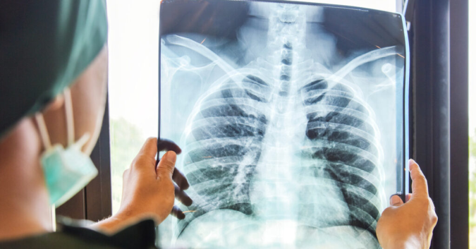 Lutte contre la tuberculose: 53 % des nouveaux cas enregistrés au Maroc en 2025 concernent des formes extra-pulmonaires